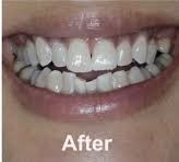 Before teeth whitening